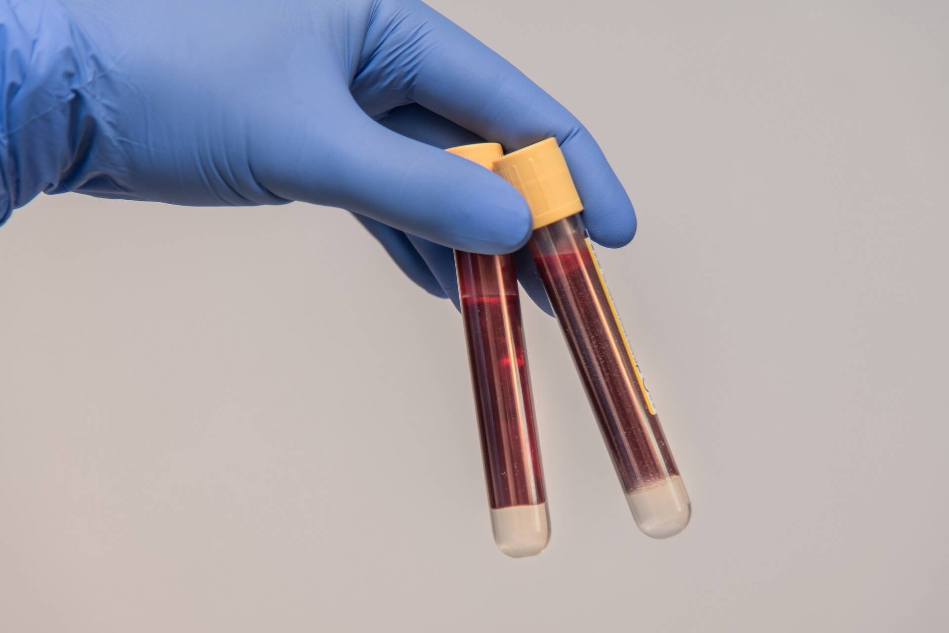 Immagine: prelievo sangue